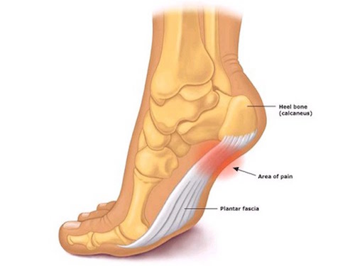 Whole Foot Pain - Buderim Podiatry