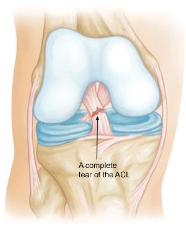 Anterior Cruciate Ligament (ACL) Tear causing Knee Pain