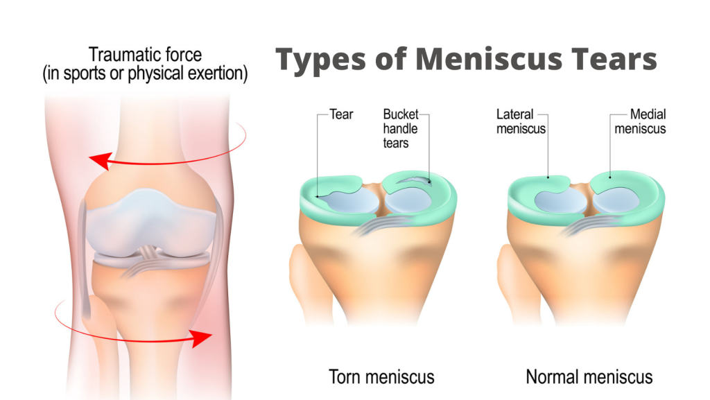 Meniscus Tear causing Knee Pain