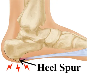 Heel Spur vs. Plantar Fasciitis